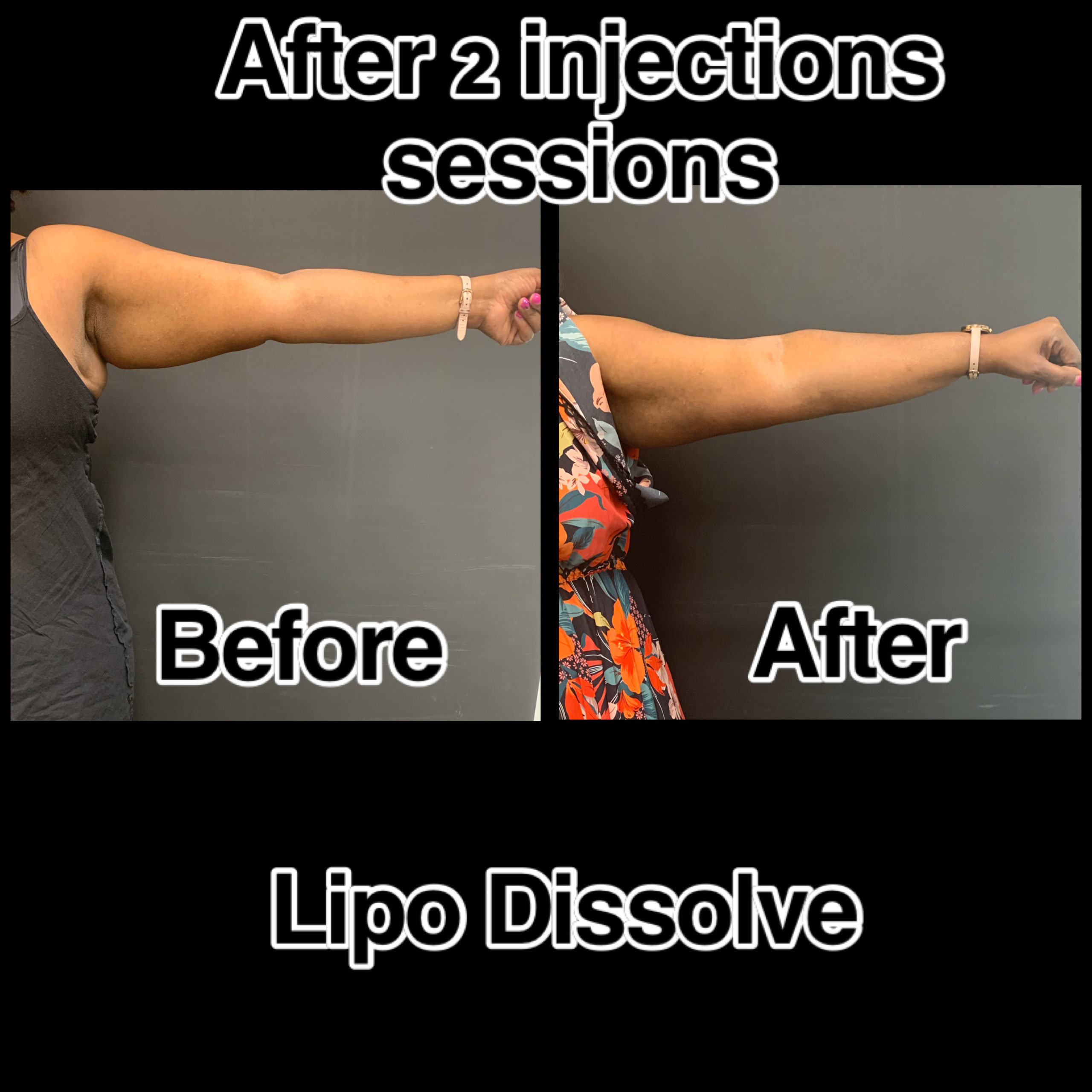 Mesotherapy Before & After Photos | The Better Body Shop MedSpa In Houston, TX