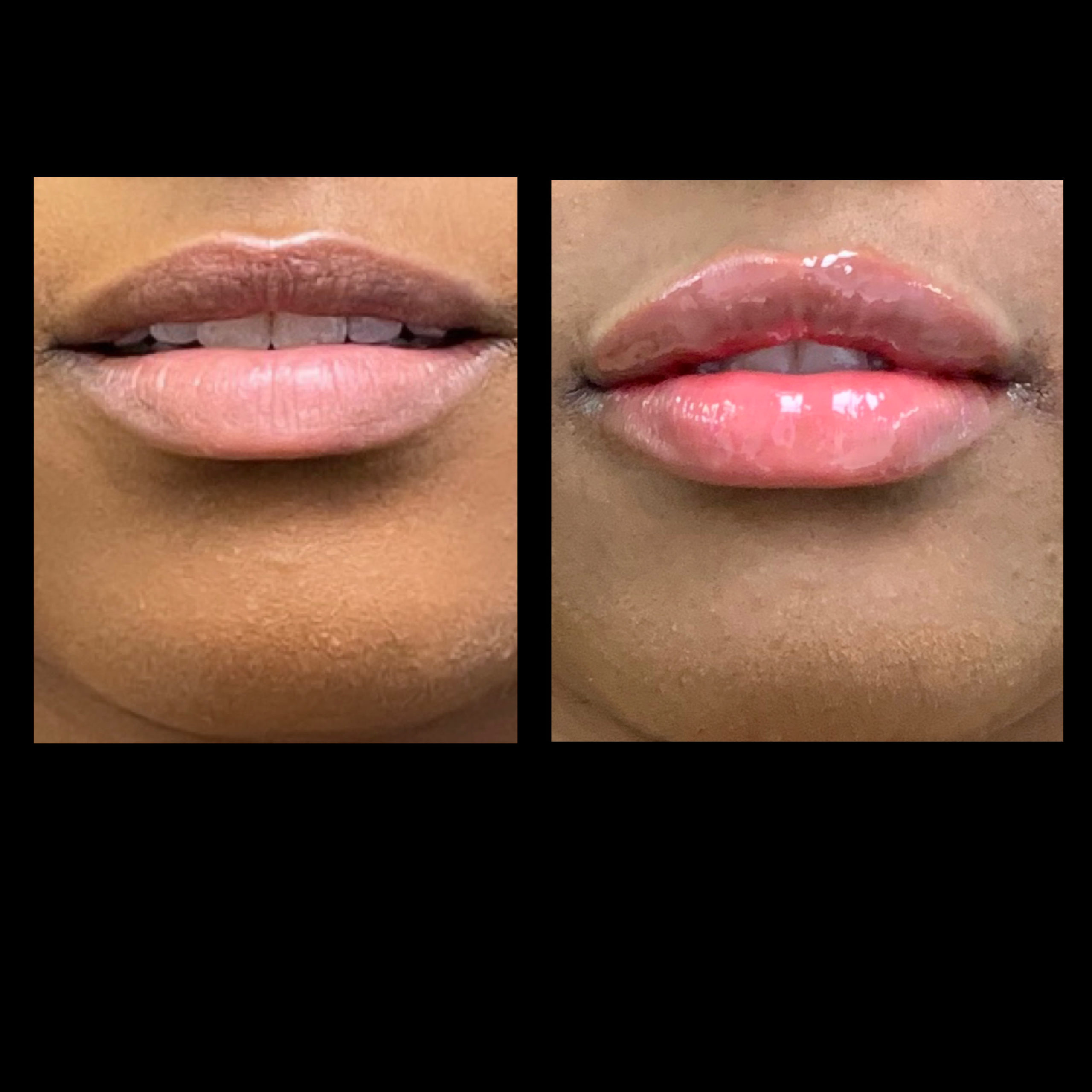 Lip Plump Before & After Photos | The Better Body Shop MedSpa In Houston, TX