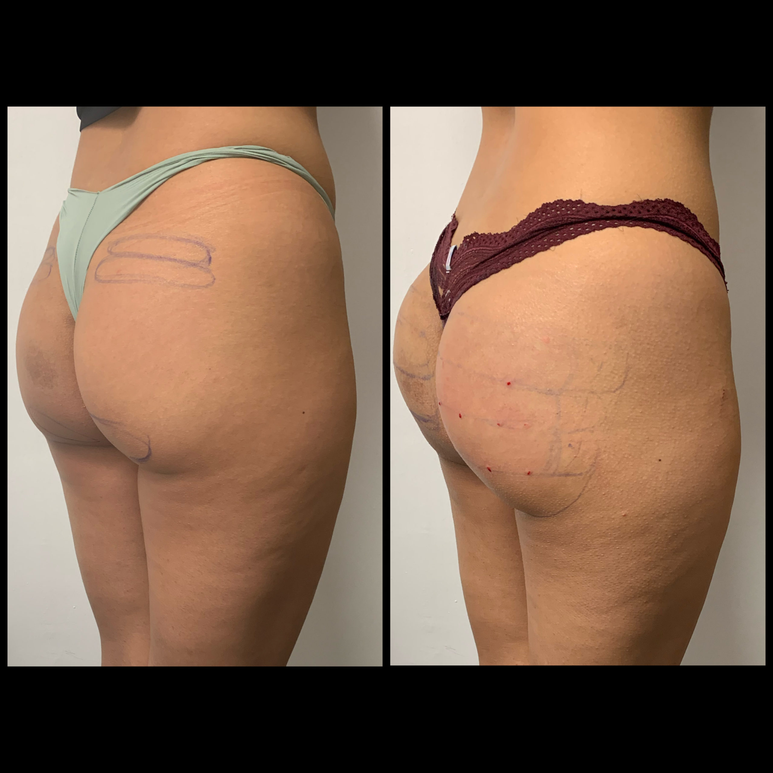 Sculptra BBL Before & After Photos | The Better Body Shop MedSpa In Houston, TX