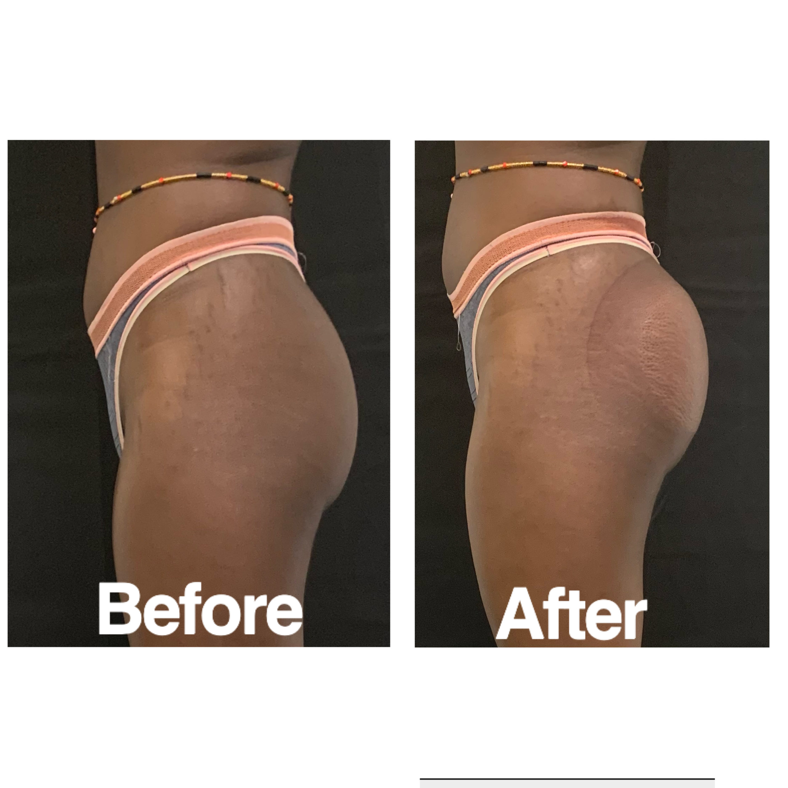 Vacuum Brazilian Butt Lift Before & After Photos | The Better Body Shop MedSpa In Houston, TX