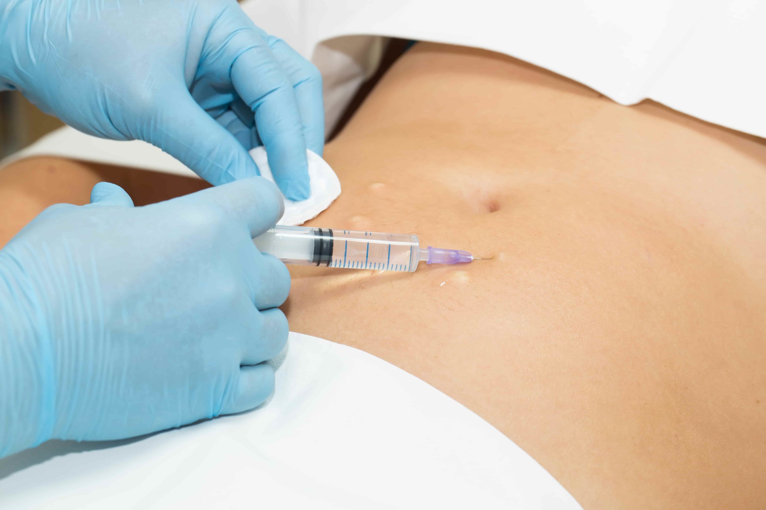 What is Mesotherapy And How Many Treatments Do You Need