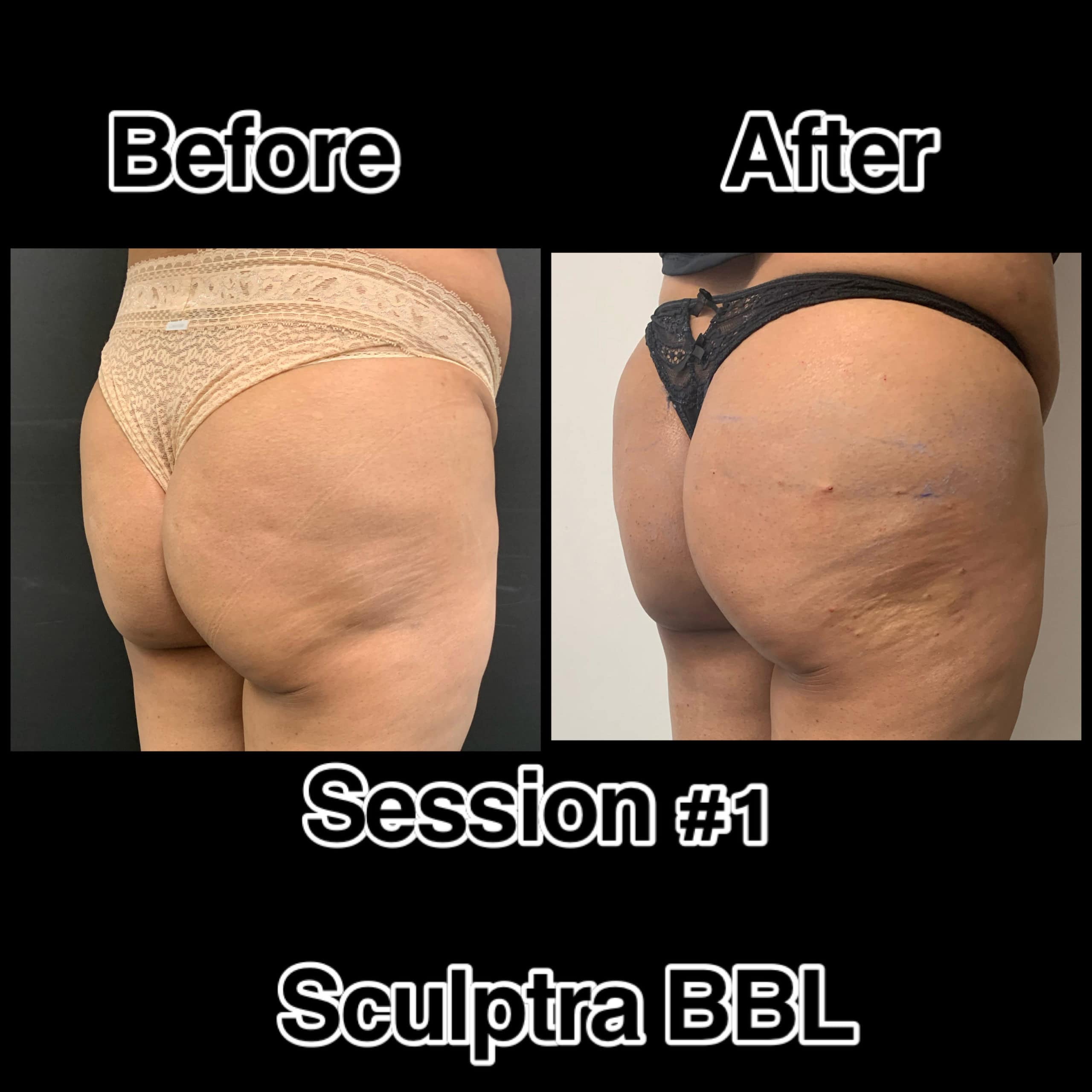 Sculptra BBL Before & After Photos | The Better Body Shop MedSpa In Houston, TX