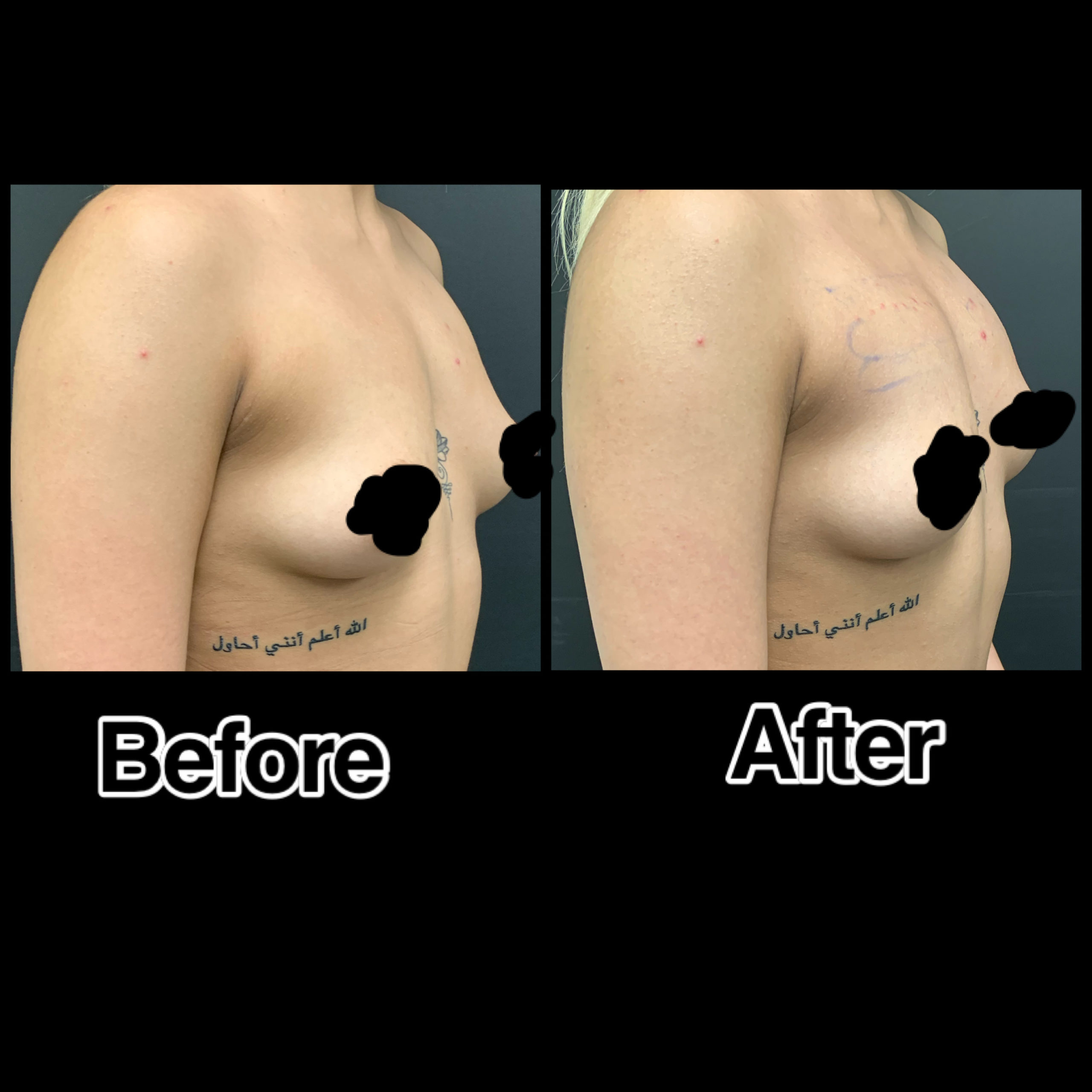 Sculptra Breast Lift Before & After Photos | The Better Body Shop MedSpa In Houston, TX