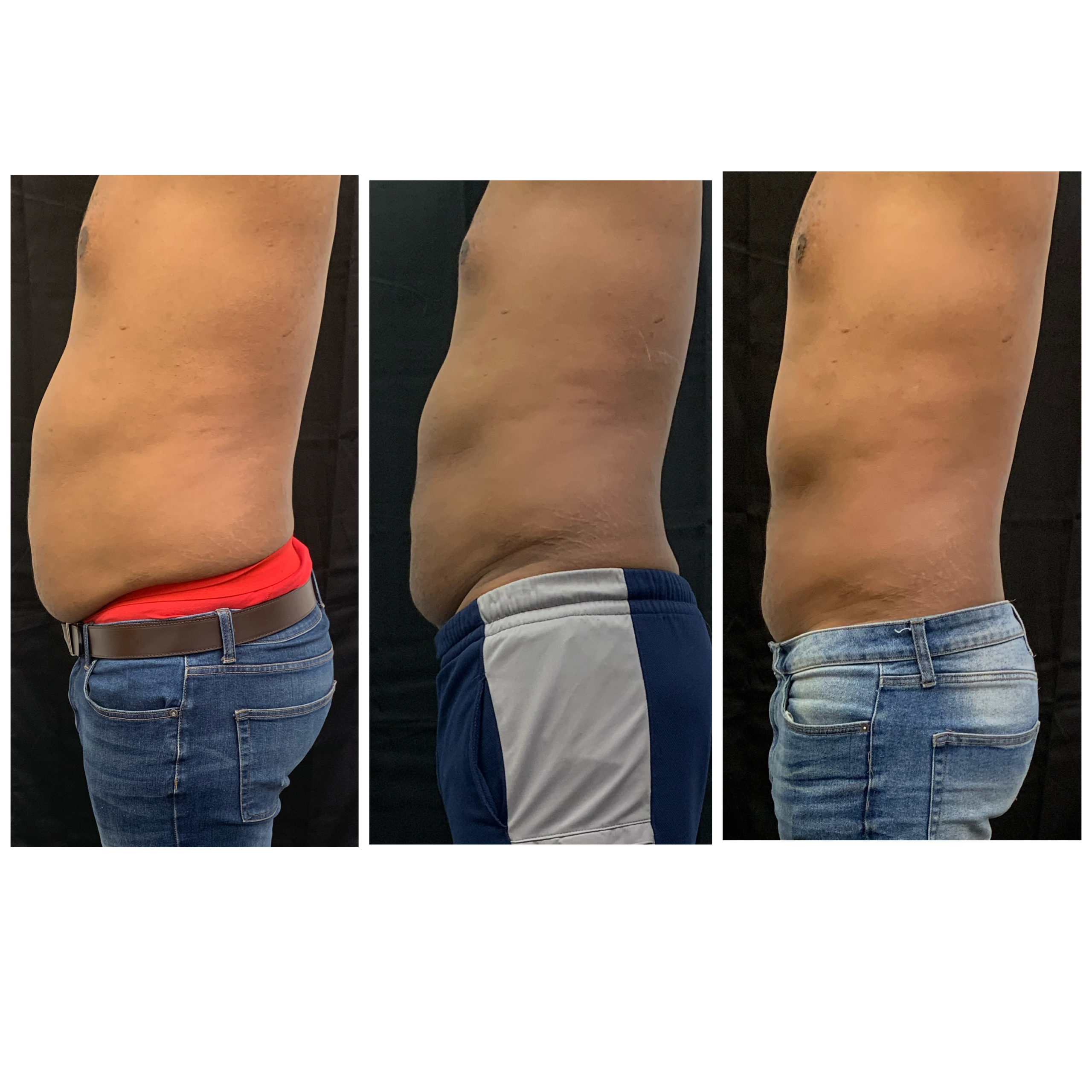 Radiofrequency Before & After Photos | The Better Body Shop MedSpa In Houston, TX