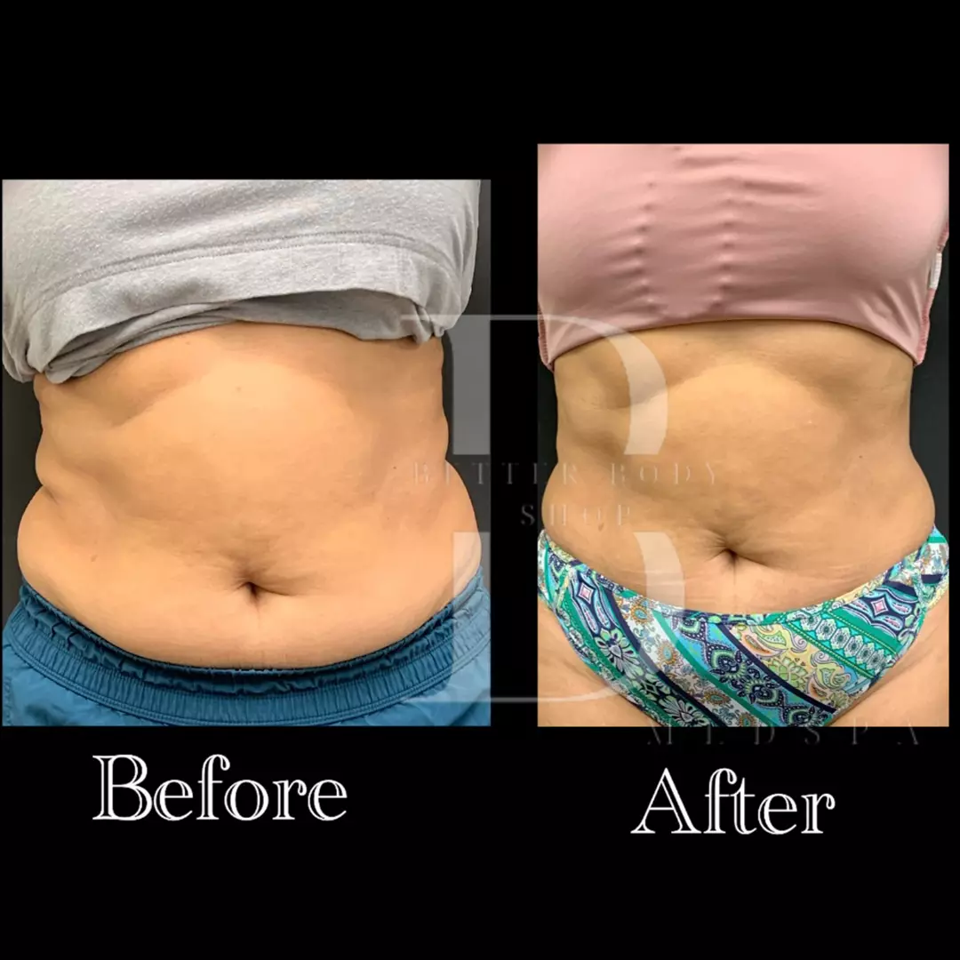 Before-and-after photo of a patient’s abdomen showing a slimmer waistline, reduced belly fat, and smoother contour after body contouring treatment at The Better Body Shop MedSpa in Houston, TX.