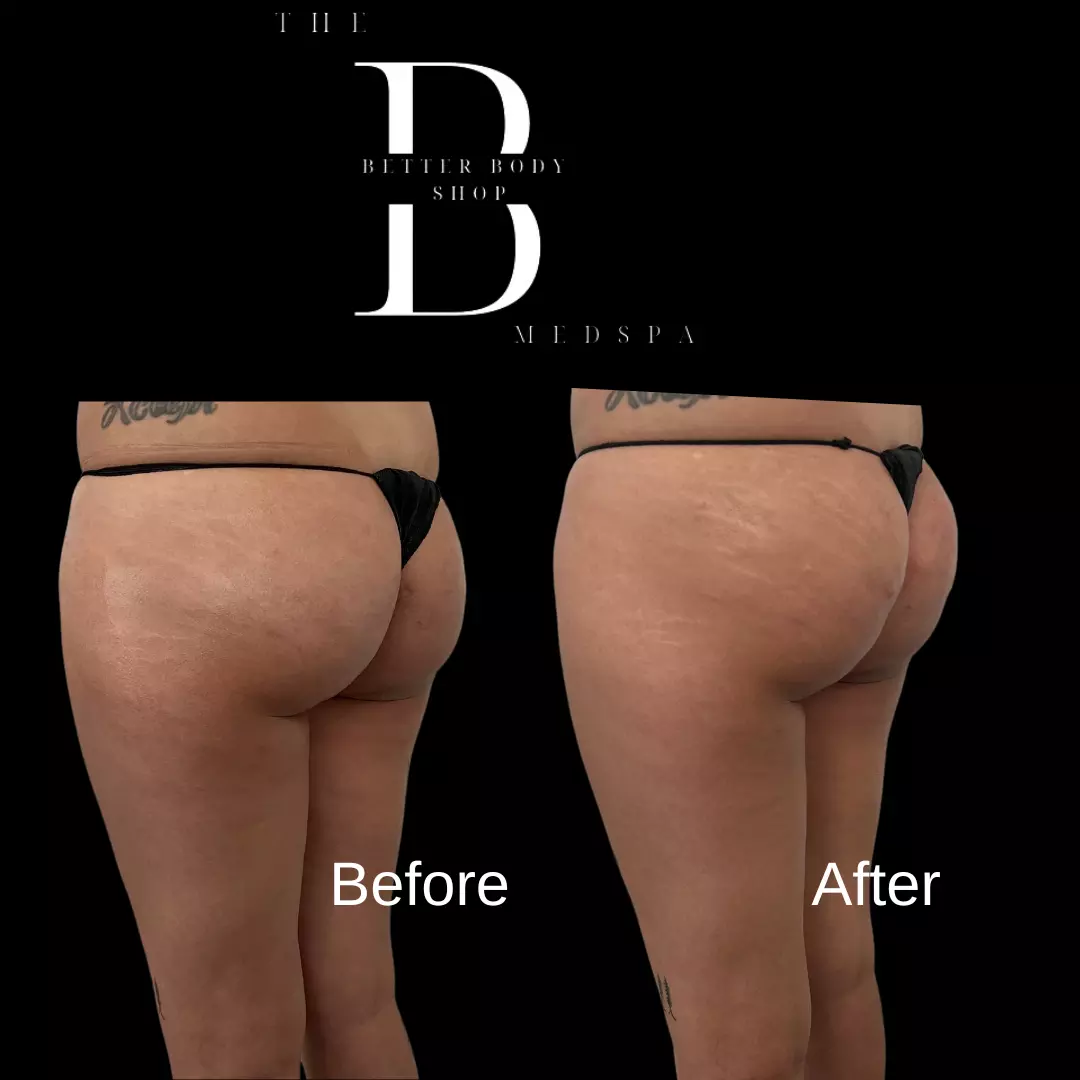 Before-and-after photo of a patient’s buttocks showing fuller volume, lifted shape, and smoother contour after Sculptra BBL treatment at The Better Body Shop MedSpa in Houston, TX.