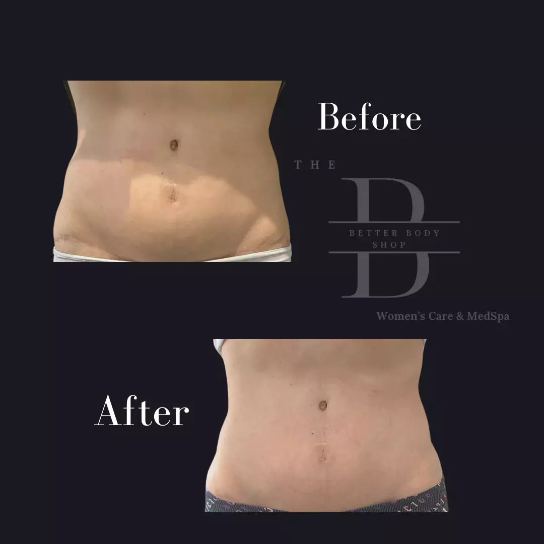 Before-and-after photo of a patient’s abdomen showing a slimmer waistline and reduced belly fat after body contouring treatment at The Better Body Shop MedSpa in Houston, TX.