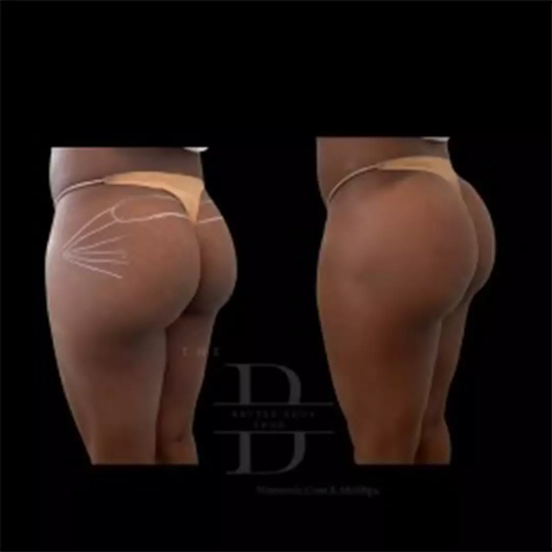 Before-and-after photo of a patient’s buttocks showing noticeable lifting and enhanced volume from Sculptra BBL treatment at The Better Body Shop MedSpa in Houston, TX.