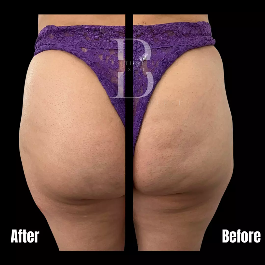 Before-and-after photo of a patient’s buttocks showing added volume and a lifted, rounder shape after Sculptra BBL treatment at The Better Body Shop MedSpa in Houston, TX