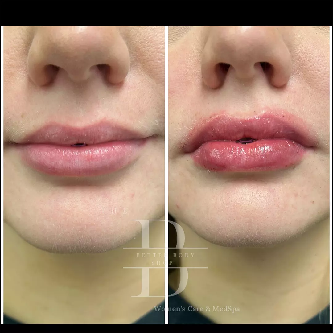 Before-and-after photo of a patient’s lips showing fuller shape and enhanced definition after dermal filler treatment at The Better Body Shop MedSpa in Houston, TX