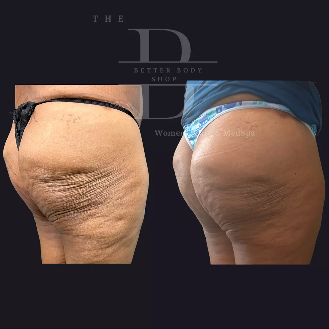 Side-by-side before and after images of a patient’s buttocks showing enhanced shape and smoother contours, likely highlighting results of a Brazilian Butt Lift or similar body contouring treatment at The Better Body Shop MedSpa in Houston, TX.