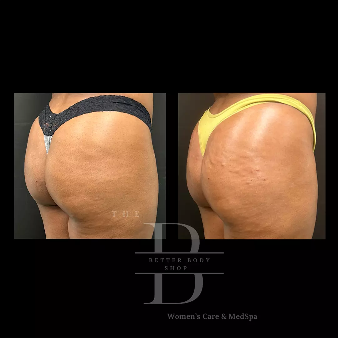 Side-by-side before and after of a patient’s midsection showing a noticeably smoother and more toned abdomen following treatment at The Better Body Shop MedSpa in Houston, TX.