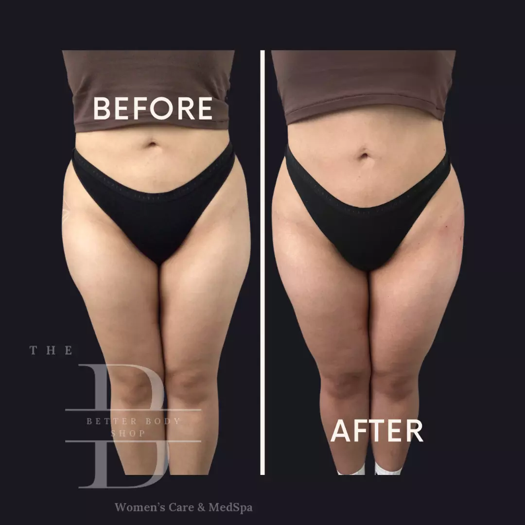 Side-by-side before-and-after photo of a patient’s midsection and hips showing a more defined waist and smoother silhouette after treatment at The Better Body Shop MedSpa in Houston, TX.