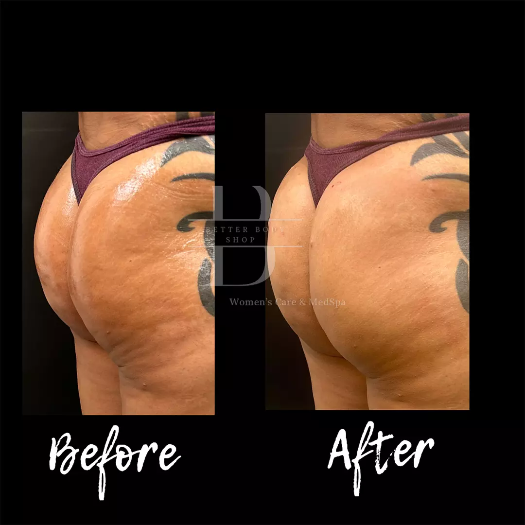 Side-by-side before and after image of a patient’s buttocks showing enhanced volume and lift achieved through Sculptra BBL treatment at The Better Body Shop MedSpa in Houston, TX.