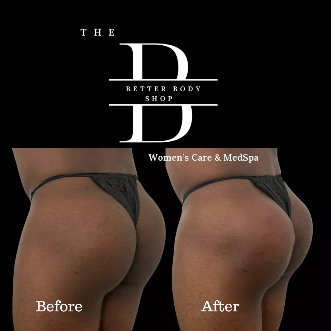 Sculptra BBL at The Better Body Shop MedSpa in Houston, TX, enhanced the patient's buttocks volume and shape (before & after).