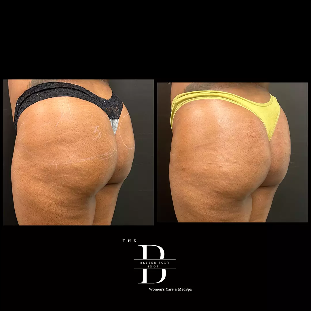 Side-by-side before and after image of a patient’s buttocks showing enhanced volume and lifted shape following Sculptra BBL treatment at The Better Body Shop MedSpa in Houston, TX.