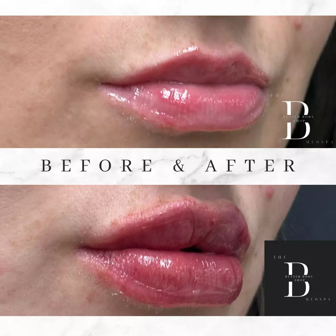 Before-and-after photo of a patient’s lips showing added volume and definition following a dermal filler treatment at The Better Body Shop MedSpa in Houston, TX.