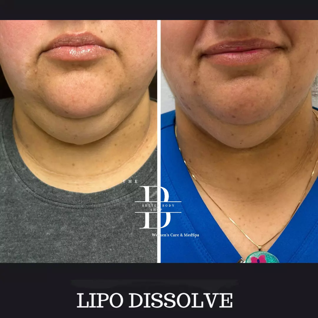 Side-by-side before and after image of a patient’s chin and jawline showing noticeable reduction in submental fullness after Lipo Dissolve treatment at The Better Body Shop MedSpa in Houston, TX.
