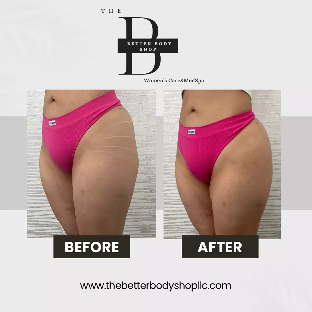 Before-and-after photo of a patient’s midsection and hips showing noticeable contouring results at The Better Body Shop MedSpa in Houston, TX.
