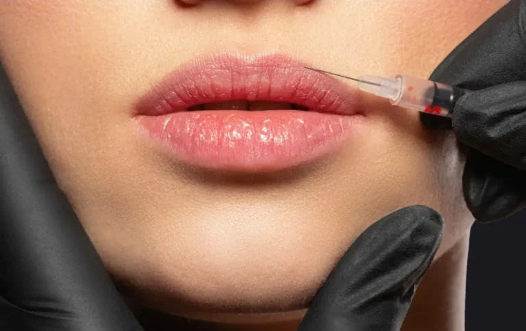 A provider carefully injects dermal filler into a patient’s lips, enhancing shape and volume with precision at The Better Body Shop MedSpa in Houston, TX