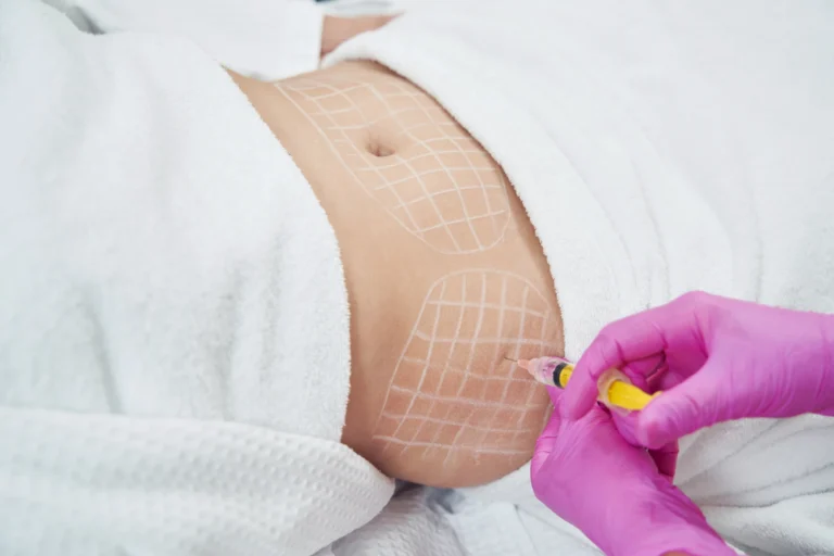 A provider’s gloved hand carefully injects a treatment solution into the target area, illustrating a personalized mesotherapy Lipo Dissolve session at The Better Body Shop MedSpa in Houston, TX.