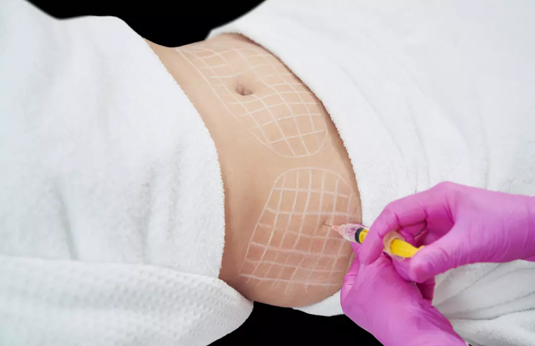 Lipo Dissolve injection treatment on the abdominal area at The Better Body Shop LLC, Houston, TX, targeting localized fat reduction.